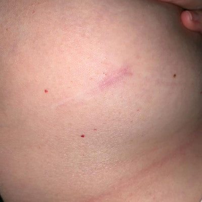 Caroline* - Scar
