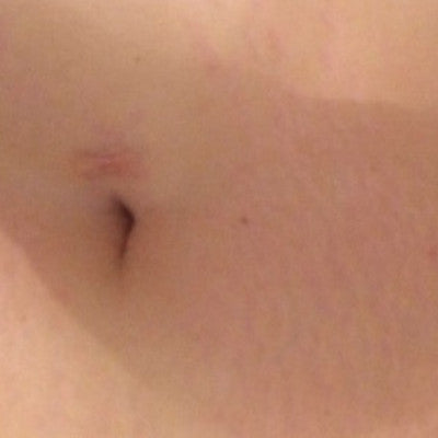 Georgina B * - Stretch Marks