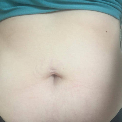 Lucy * - Stretch Marks