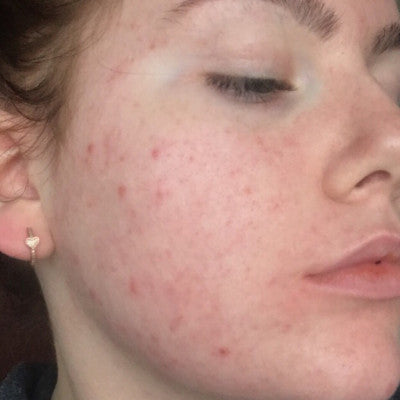 Jade* - Acne scar