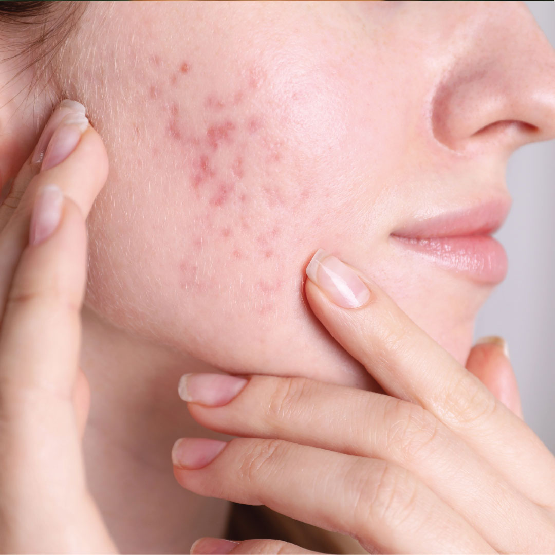 Acne Scarring