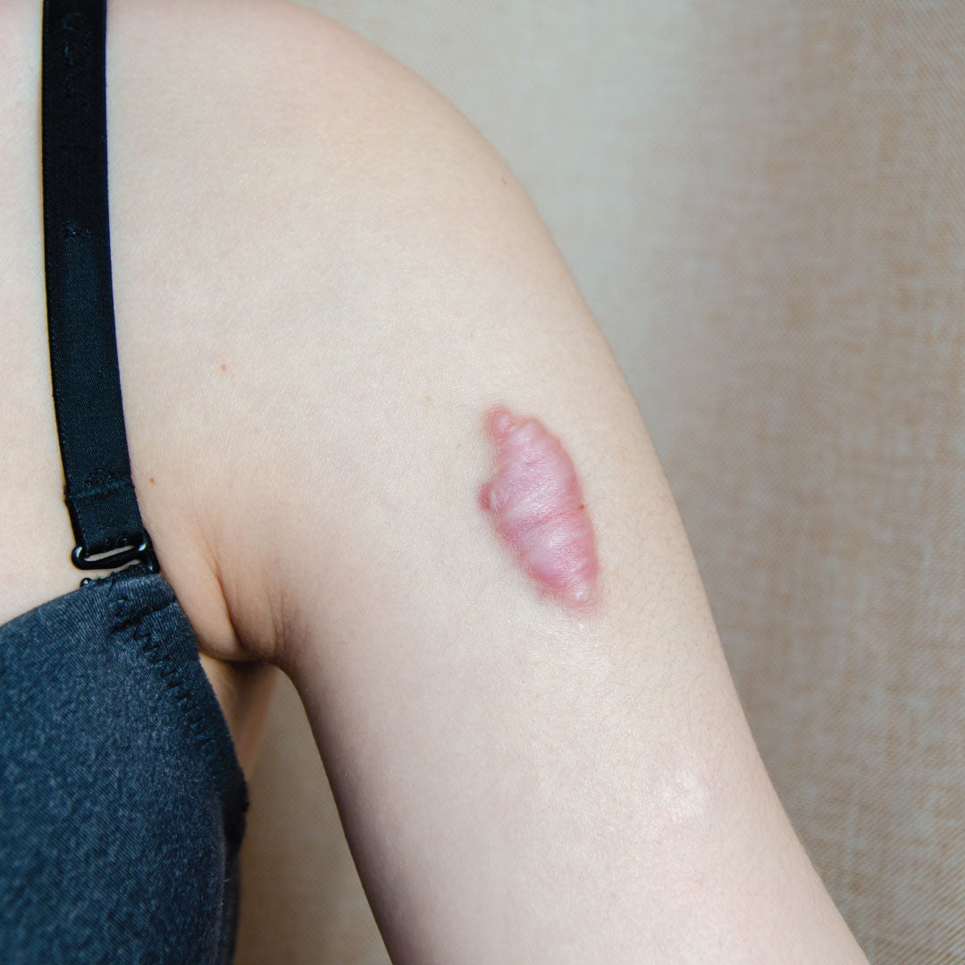 Keloid Scars