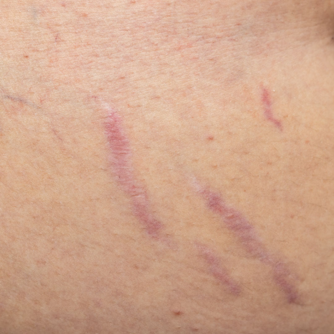 Stretch Marks