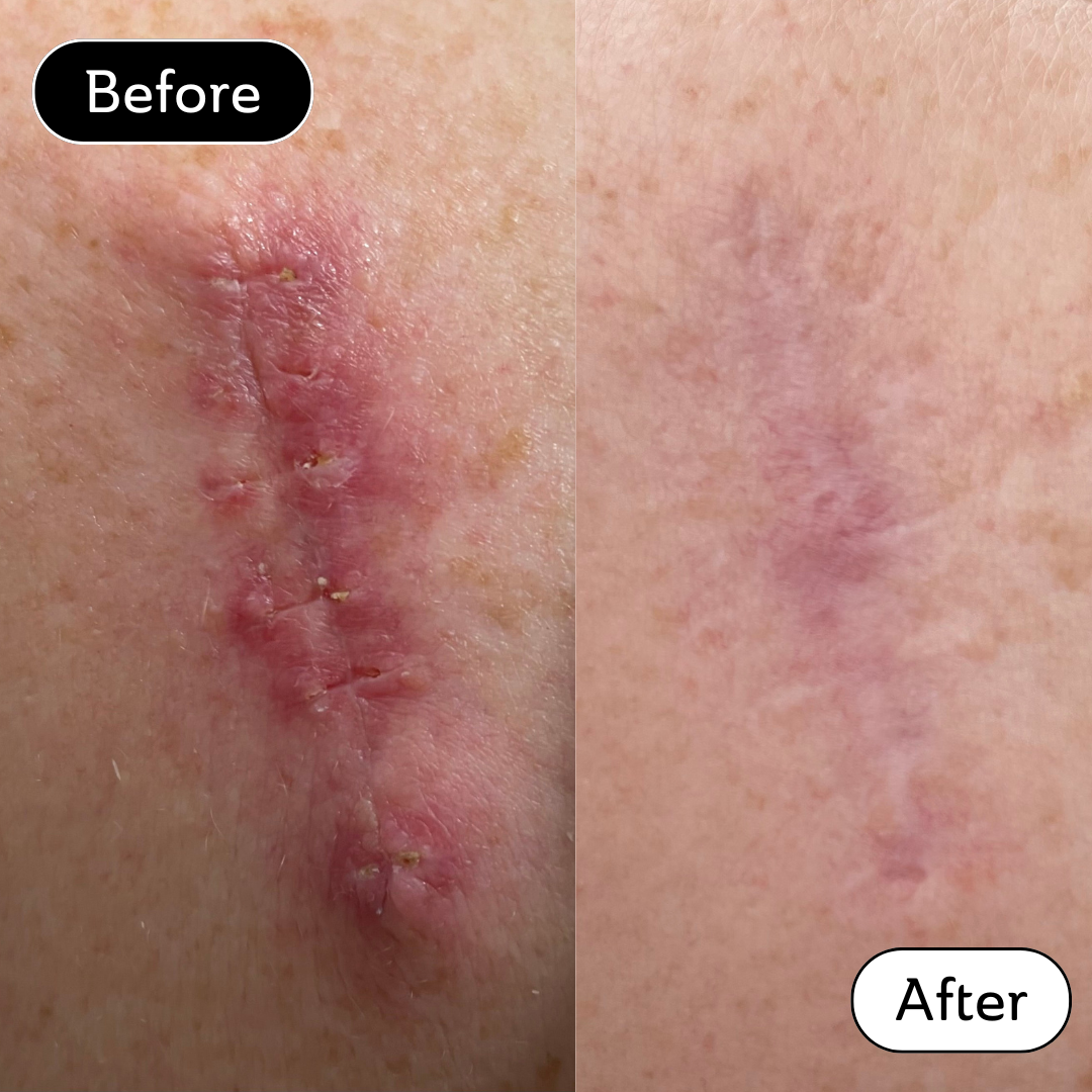 Vicki - Skin Cancer Removal
