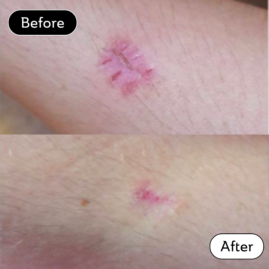 Gillian – surgical scar* - Scar