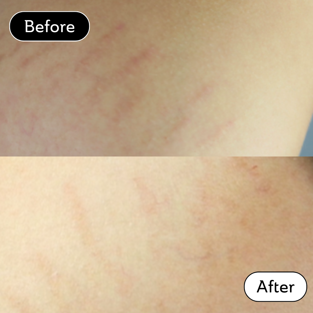 Beauty blogger, LittleMehrBlog * - Stretch Marks
