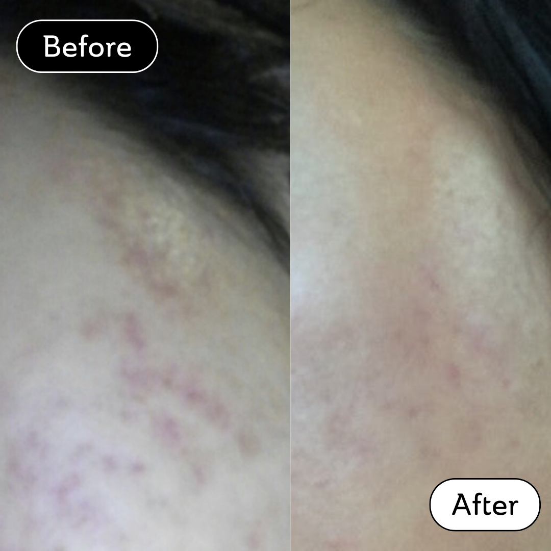 Yuzra* - Acne scar