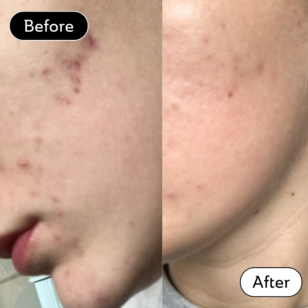 Danielle* - Acne Scar