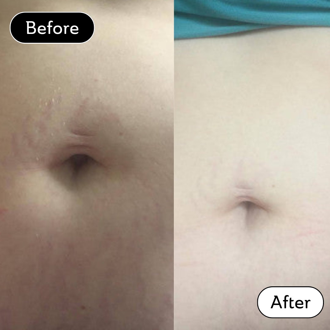 Lucy * - Stretch Marks