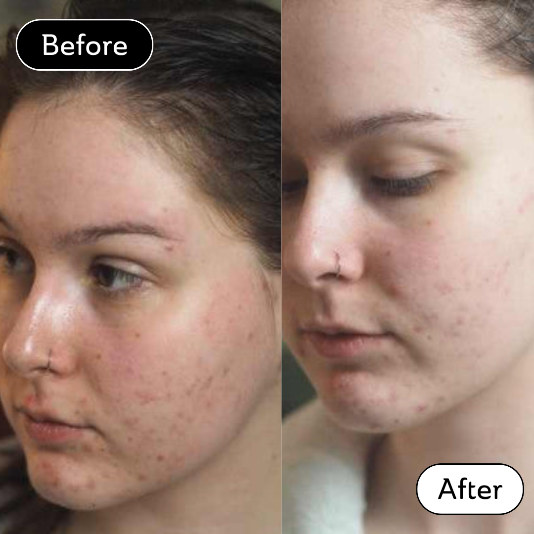 Loulabelle Rose* - Acne scar