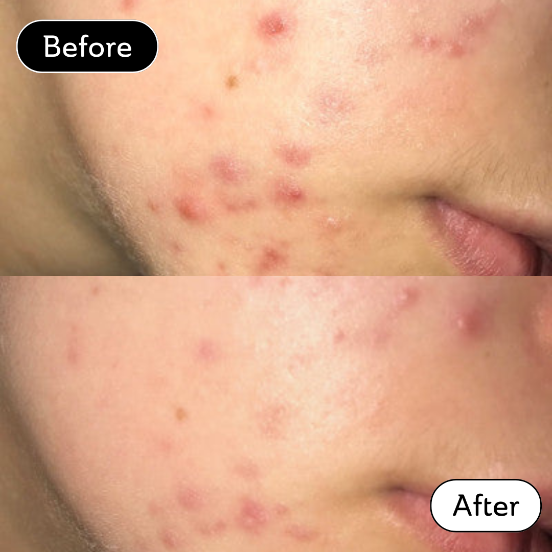 Olivia* - Acne scar