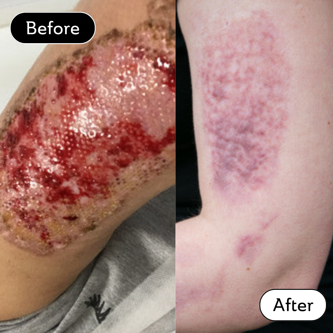 Kate* - Burn scar