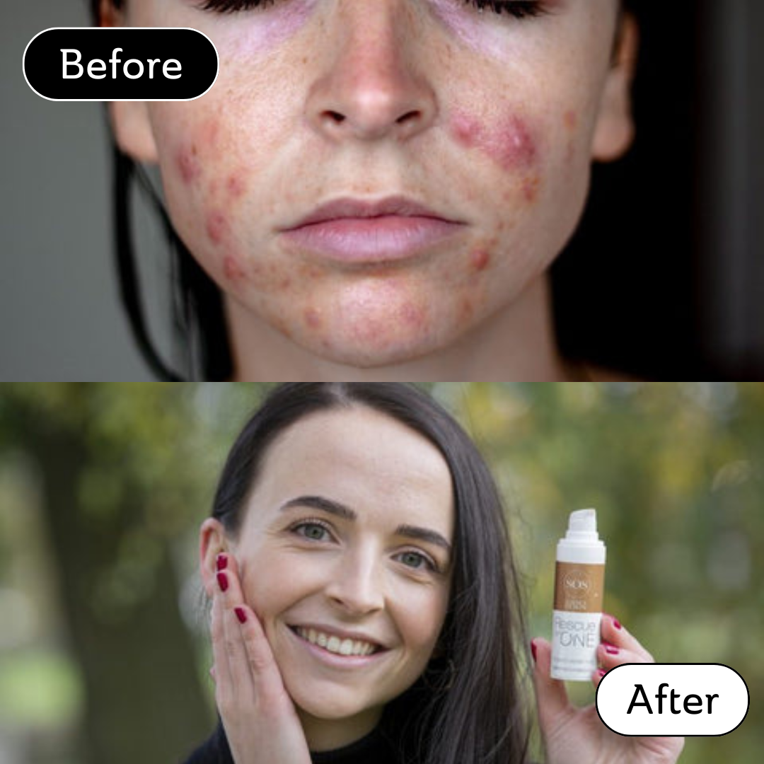 Alice* - Acne scar
