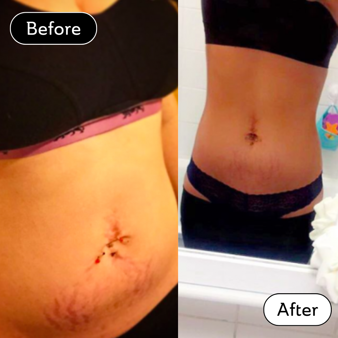 Harry Amelia * - Stretch Marks