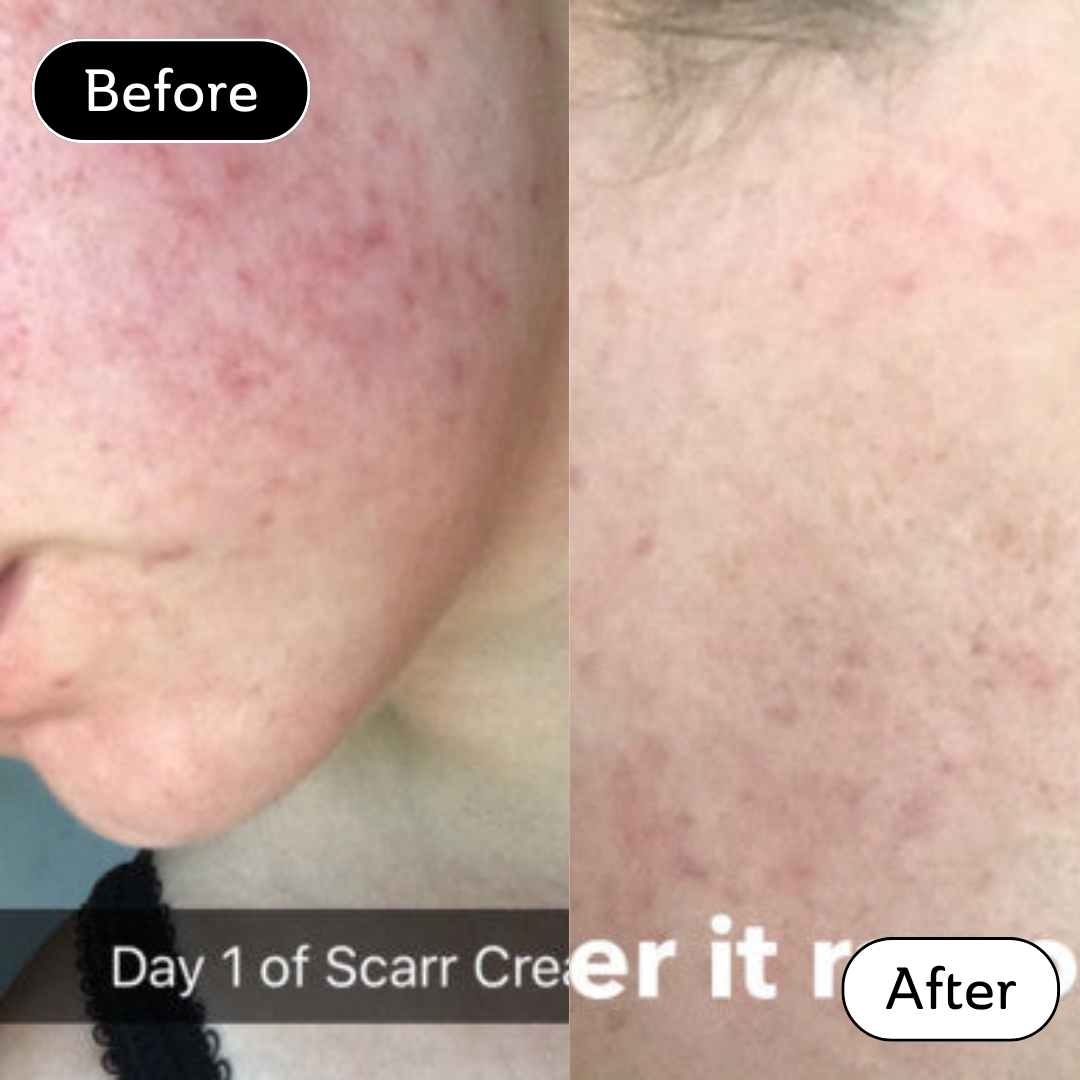 Anna* - Acne scar