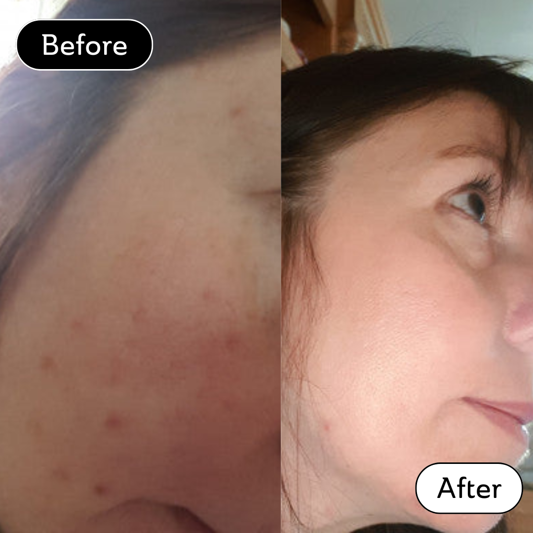 Amanda* - Acne scar