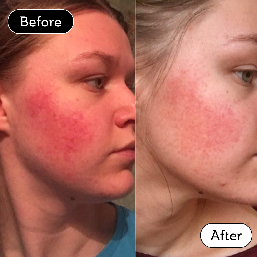 Nicole* - Rosacea