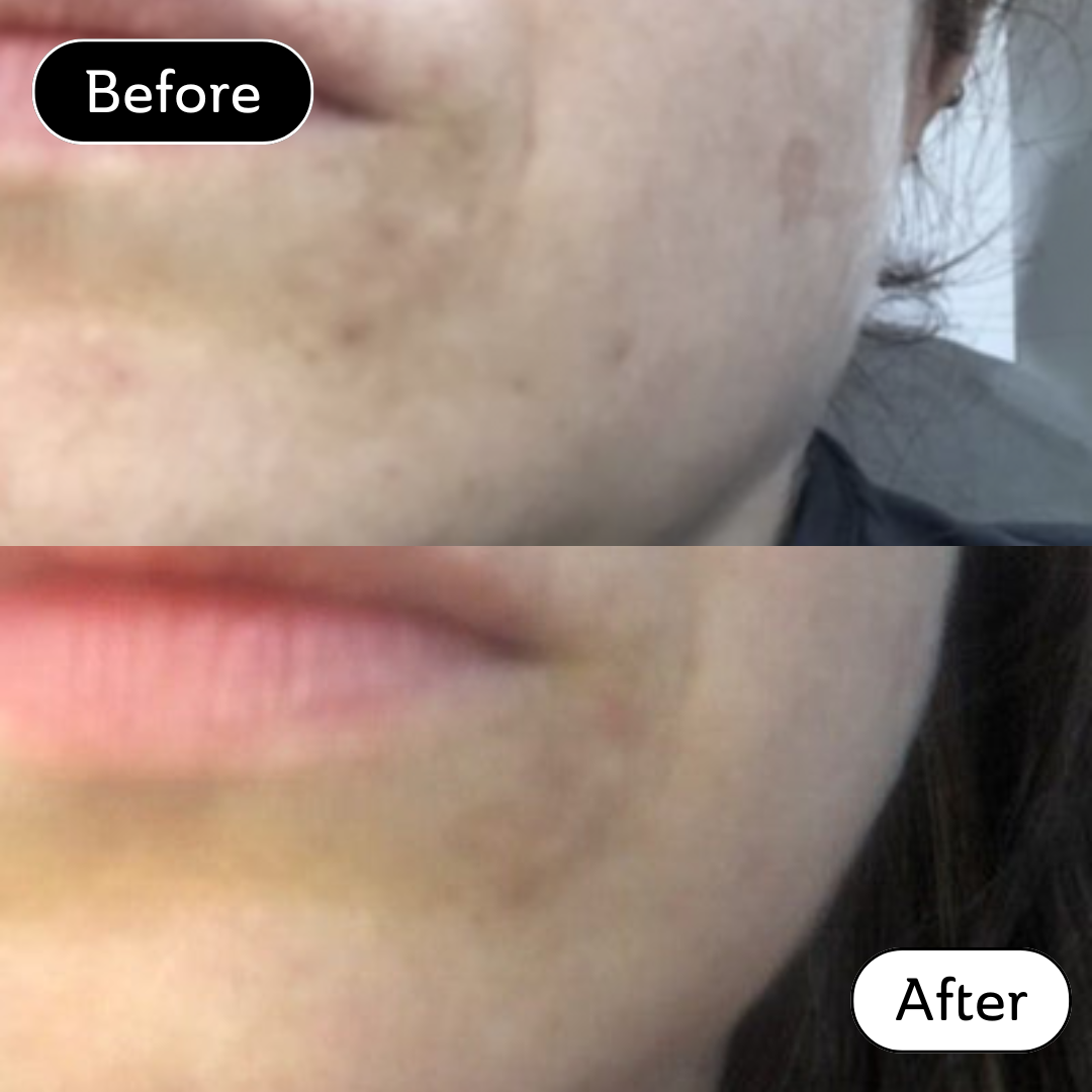 Gillian* - Acne scar