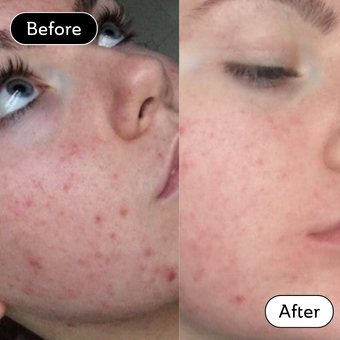 Jade* - Acne scar