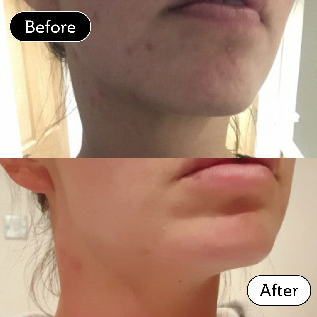 Vicky* - Acne scar