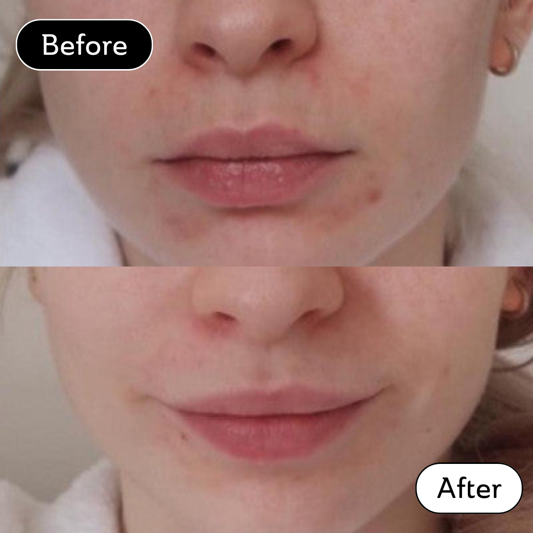 Katie* - Acne scar