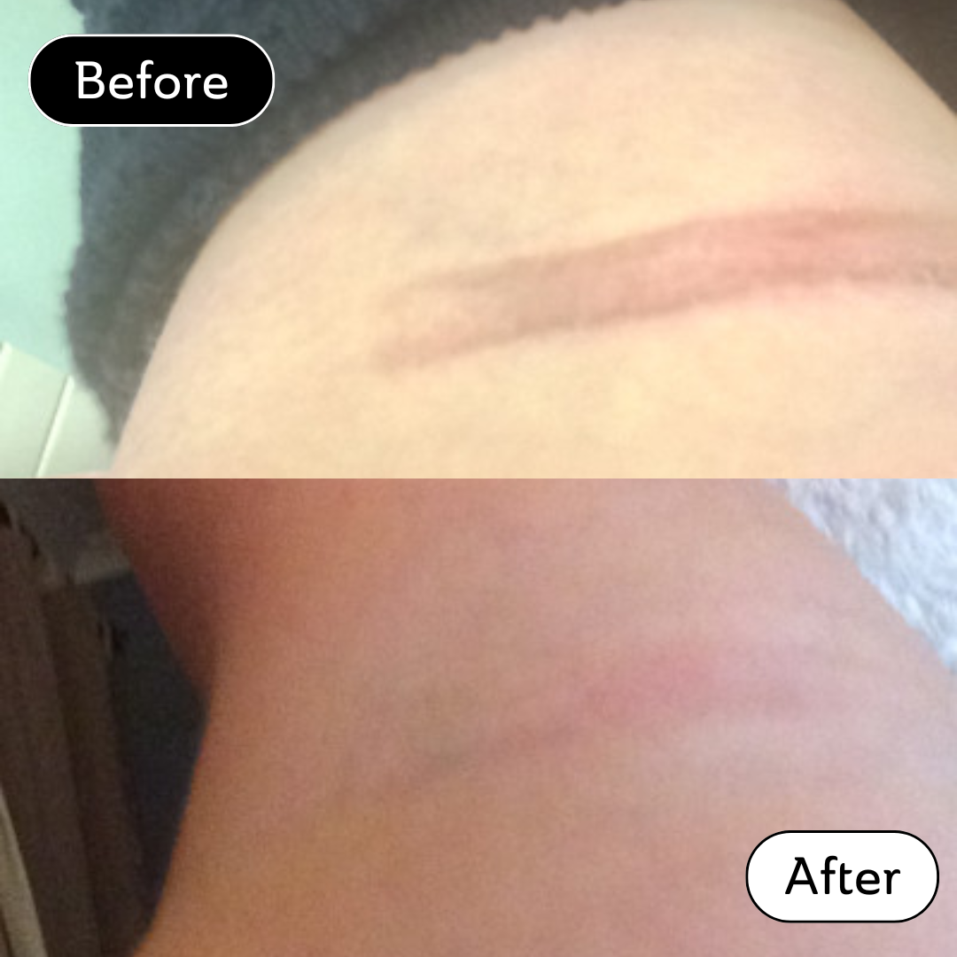 Emma* - Burn scar