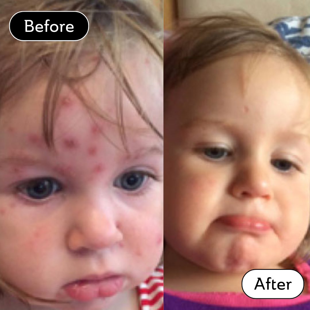 Martha* - Chicken Pox scar