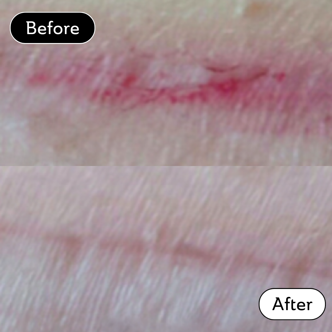 Helen* - C-Section Scar