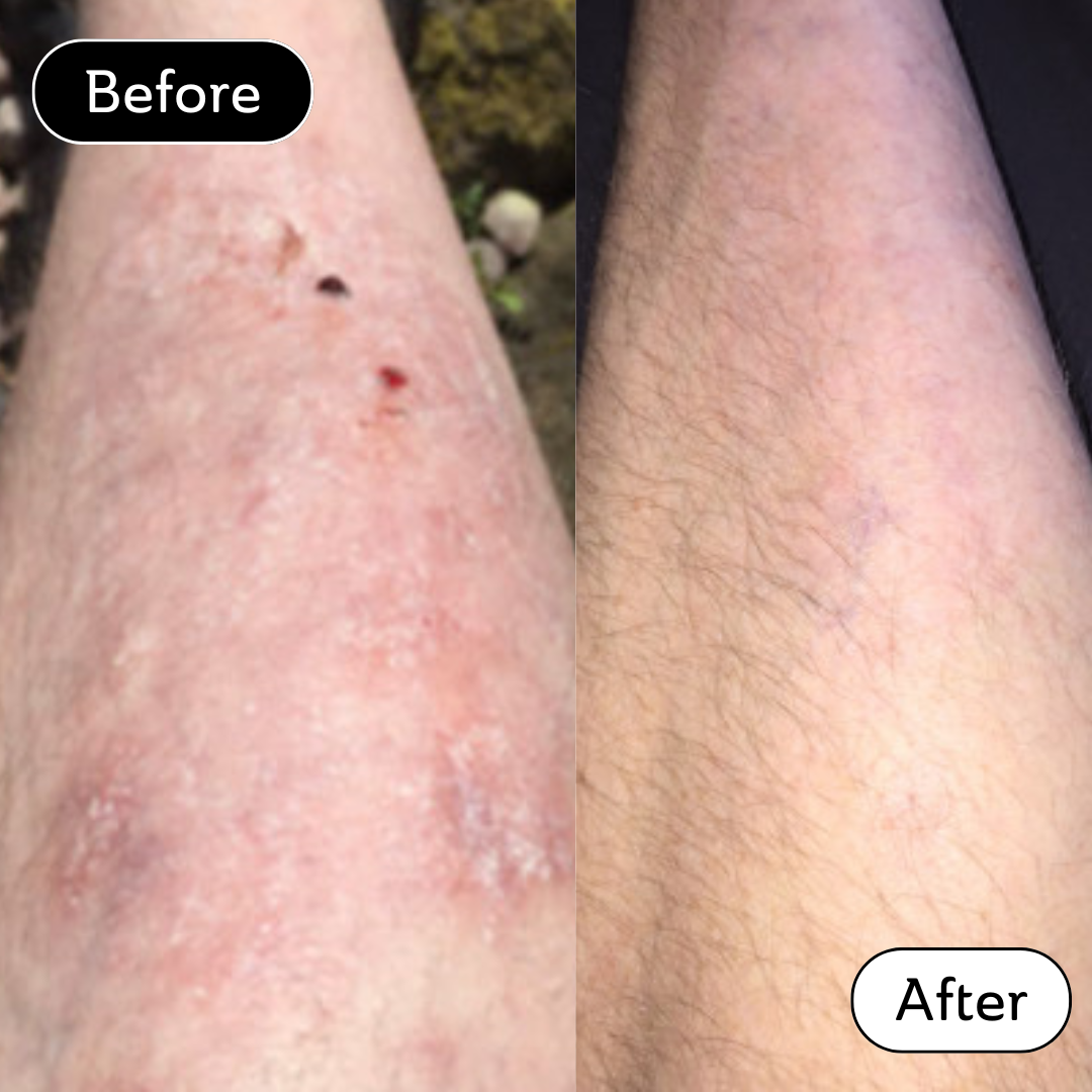 Mark* - Eczema Scars