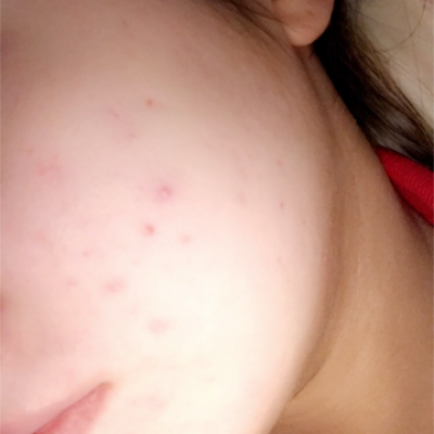 Cliona* - Acne scar