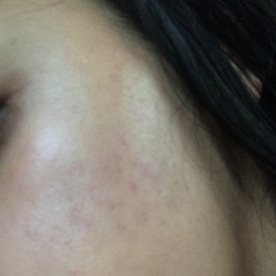 Yuzra* - Acne scar
