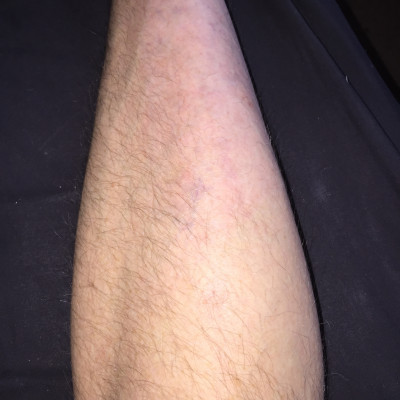 Mark* - Eczema Scars