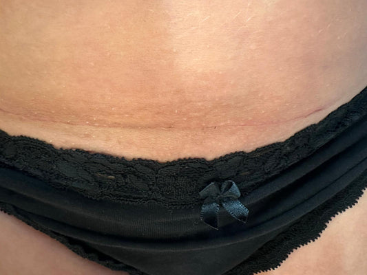 Antonia C-Section Scar*