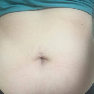 Lucy * - Stretch Marks