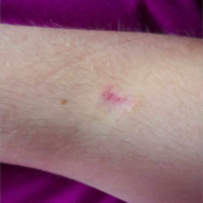Gillian – surgical scar* - Scar