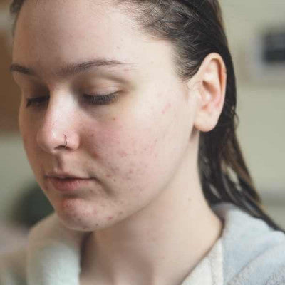 Loulabelle Rose* - Acne scar