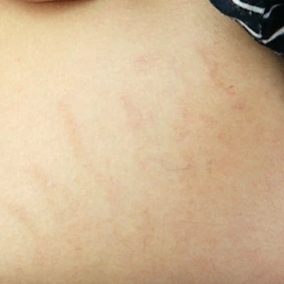 LittleMehrBlog * - Stretch Marks
