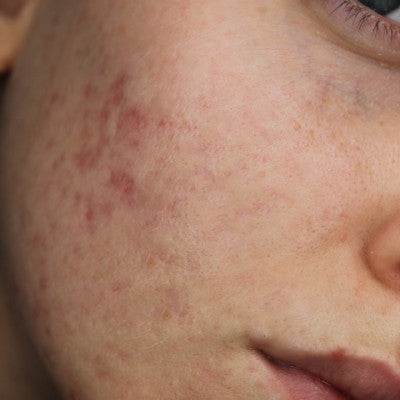 Louisa* - Acne scar