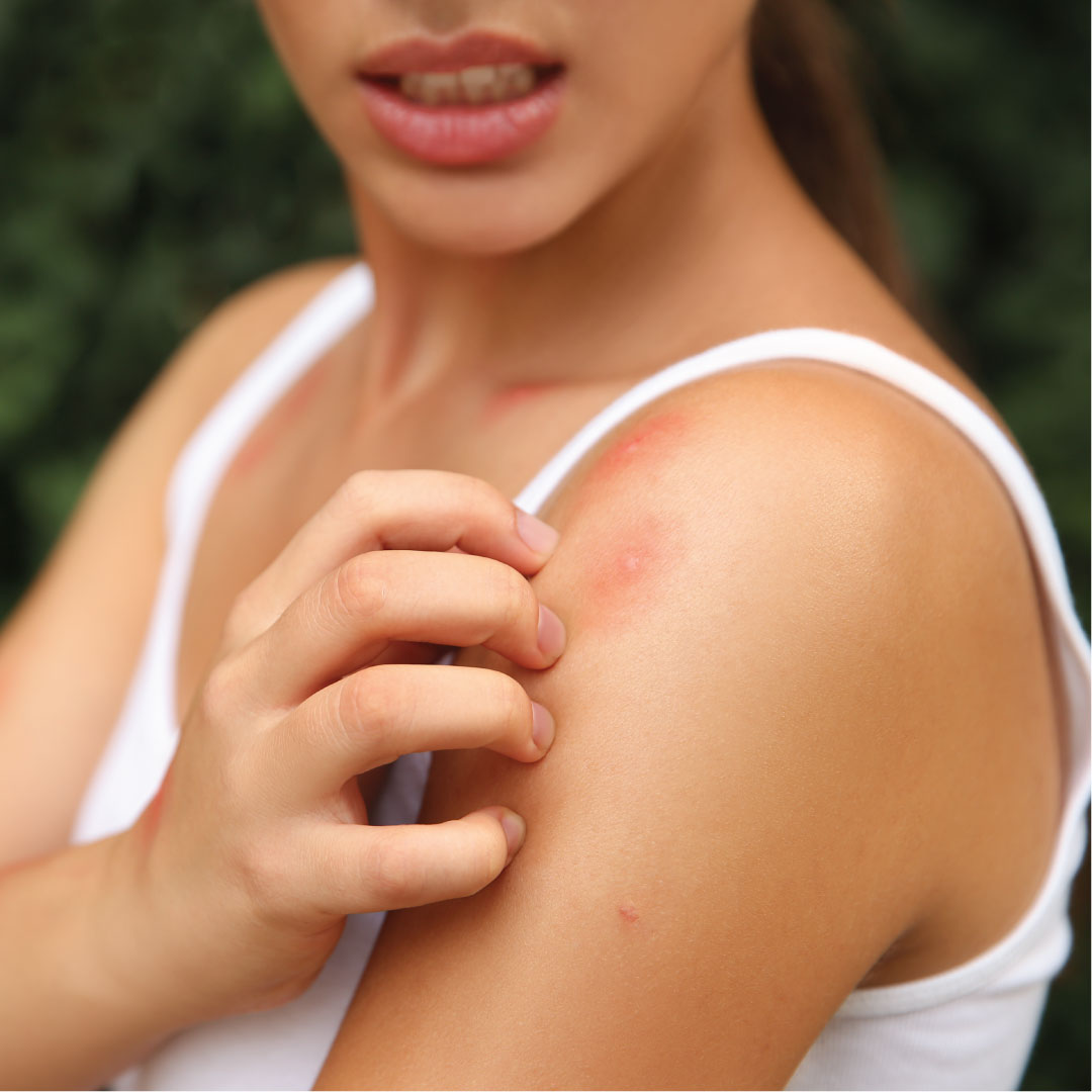 Insect Bites