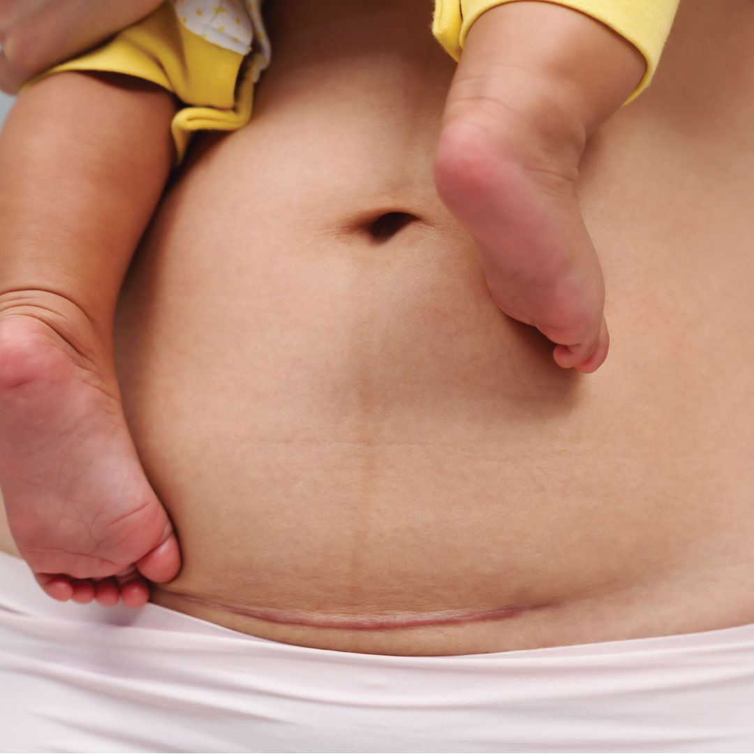 C-Section