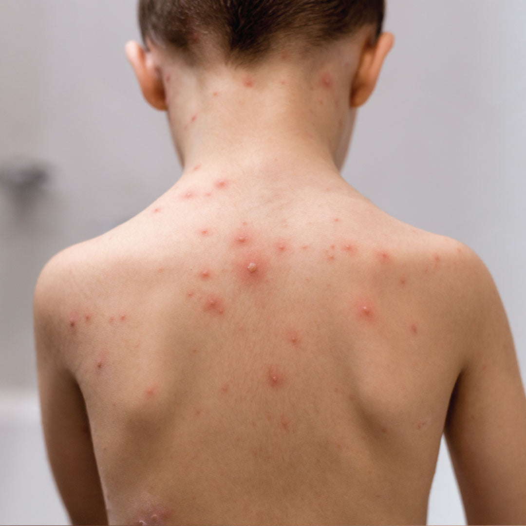 Chickenpox