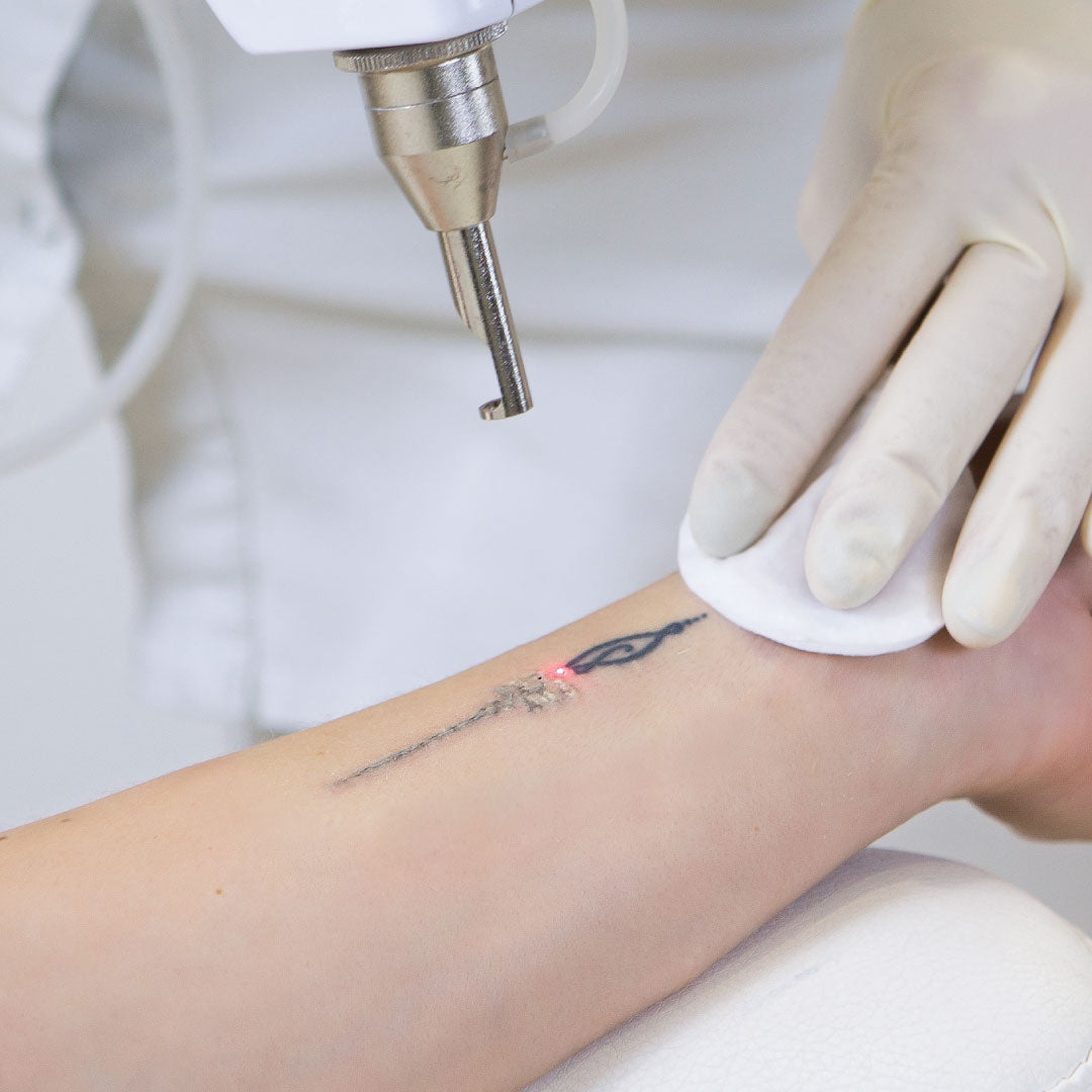 Laser Scars